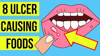 8 FOODS and DRINKS causing MOUTH ULCERS Canker sore  Plus treatment [upl. by Bodkin408]