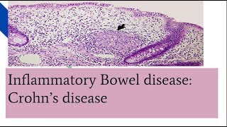 Crohns disease PathogenesisMorphology and clinical features [upl. by Alsworth]