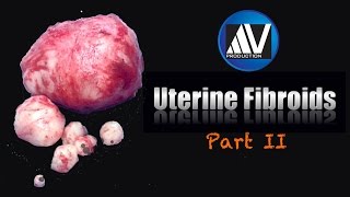 Fibroids Part II [upl. by Ocsic]