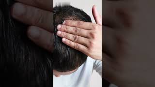 Minoxidil  Uses  Side Effects  Precautions shorts viralvideo [upl. by Einhpets289]