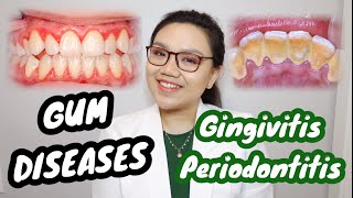 GUM DISEASE Gingivitis and Periodontitis 🦷 Namamagang gilagid masama ba  Dr Bianca Beley [upl. by Damha982]