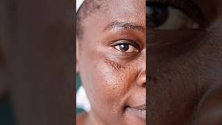 Syringoma removal at Derma skin clinic skincare skincareroutine mydermatfordarkspots [upl. by Imotas]