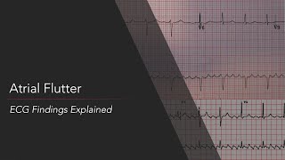 Atrial Flutter ECG Findings Explained [upl. by Herold75]