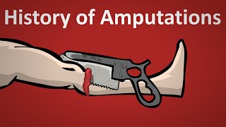 The History of Amputation Explained [upl. by Ahsilla972]