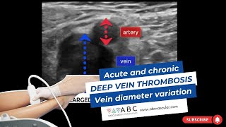 Acute and chronic Deep vein thrombosis Vein diameter variation  Ultrasound [upl. by Afrikah]