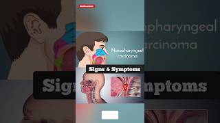 Symptoms of Nasopharyngeal Carcinoma [upl. by Allicserp]