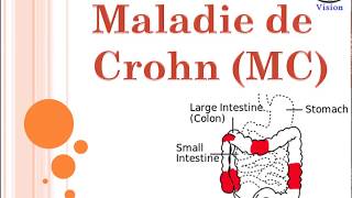 Maladie de Crohn Crohn Disease Symptomes Diagnostic Spondylarthropathies [upl. by Stclair]