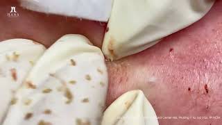 Big Cystic Acne Blackheads Extraction Blackheads amp Milia Whiteheads Removal Pimple Popping [upl. by Donatelli]