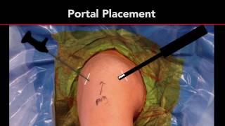 Calcific Tendonitis Treatment  Arthroscopic Rotator Cuff Repair  Shoulder Surgeon [upl. by Nnyled463]