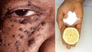 DIY skin tag removal in 3 days skin tag removal challenge natural remedy [upl. by Guod]