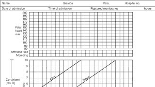 How to plot partograph  obs amp gynae  Labor [upl. by Darnoc139]