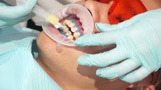 Enlighten  Teeth Whitening Instructions  London  Whites Dental [upl. by Travers]