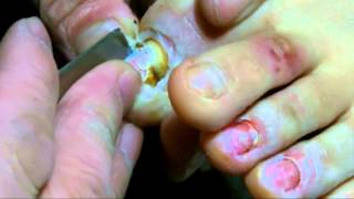 重症化した爪真菌症 治療 Onychomycosis treatment was severe [upl. by Yahsal356]