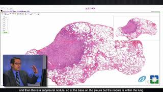 Pathology Insights Lung Granulomas Caused by Fungal Infection with Sanjay Mukhopadhyay MD [upl. by Gerta7]