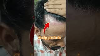 Scalp psoriasis treatment wonderful result after 60 days [upl. by Attenwad]