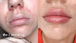 HOW I CLEARED MY PERIORAL DERMATITIS [upl. by Asserac441]