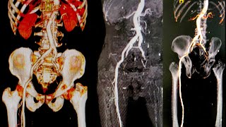 Post processing CTA Lower extremity CTA RUNOFF [upl. by Adniralc]