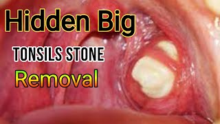 Tonsils stone removal tonsillolith removal Tonsillitis [upl. by Ahcim667]