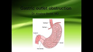 Gastric outlet obstruction [upl. by Enilreug]