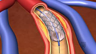 Animation  Coronary stent placement [upl. by Volnak523]