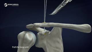 Innovative Solution for Acromioclavicular Joint Dislocation and Clavicle Fracture Surgery Animation [upl. by Kantor]