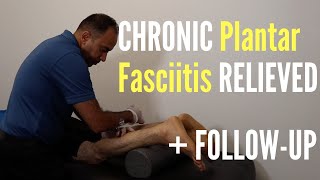 CHRONIC  Plantar Fasciitis Relieved With ASTR FOLLOWUP [upl. by Eisset]