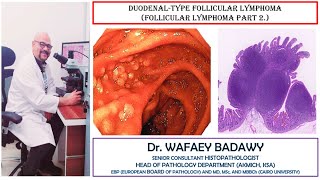 DUODENAL TYPE FOLLICULAR LYMPHOMA BY DR WAFAEY BADAWY [upl. by Sira]