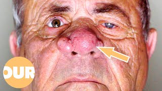 This Mans Nose Wont Stop Growing Rhinophyma Rosacea  Our Life [upl. by Atnahsal]