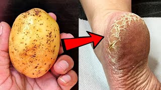 Remove cracked heels and get beautiful feet permanently Magical cracked heels home remedy [upl. by Yenalem]