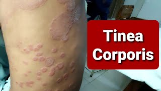 Tinea Corporis  WideSpread [upl. by Bendix]