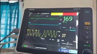 Tachypnoea in severe mitral stenosis with atrial fibrillation and fast ventricular rate [upl. by Sari807]