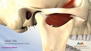 TMJ Disorder or TMD  Clicking and Closed Lock [upl. by Free]