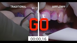 Abrasive teeth cleaning method vs AIRFLOW method [upl. by Innattirb823]