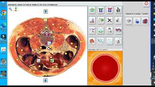 Metatron y biophilia tracker aneurisma de la aorta abdominal [upl. by Ashraf]