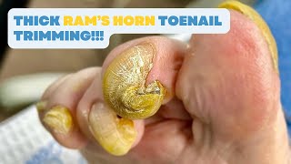 Thick RAM’S HORN TOENAIL Trimming [upl. by Buckels136]