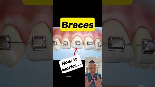 How Do Braces Move Your Teeth The Magic of Orthodontics dentallan dentist shorts [upl. by Aneleasor64]