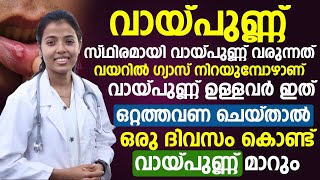 ഇത് ഒറ്റത്തവണ ചെയ്താൽ തന്നെ വായ്പുണ്ണ് ഒറ്റ ദിവസത്തിൽ മാറും  vaya punnu maran  Dr Juhi Das [upl. by Hindu946]