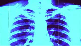 Xray Slides Of Human Lungs Organs Overlay [upl. by Neeliak78]