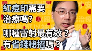 紅痘印 紅痘疤 需要治療嗎？消不掉怎麼辦？哪種雷射最有效？有省錢便宜高CP值的方法嗎？皮膚科醫師一次教你治療紅痘印的最強攻略！ [upl. by Yeslrahc]