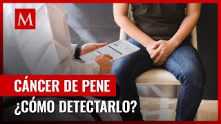 ¿Qué es el cáncer de pene y cuáles son sus síntomas [upl. by Ilrebmik]