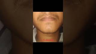 New Journey For Beard Minoxidil After Beard fall  Man Matters Beard Minoxidil  15 Month Result [upl. by Kubetz]