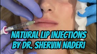 Natural Lip Injections with Juvederm Volbella [upl. by Meekyh]