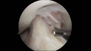 Torn Meniscus Arthroscopic Surgery [upl. by Odlareg]