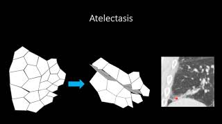 Atelectasis [upl. by Bassett]