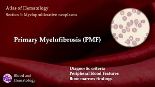 Primary Myelofibrosis PMF [upl. by Hedaza406]