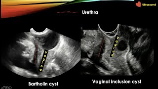 Gynaecological Ultrasound Step by Step Part 1 [upl. by Kralc]