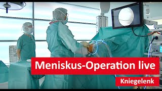 Kniegelenk MeniskusOperation live [upl. by Aetnahs]