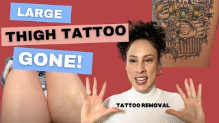 Large Thigh Tattoo Removal Pt 2 [upl. by Caddric]