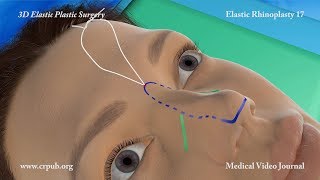 3D Elastic Rhinoplasty [upl. by Ernesta156]