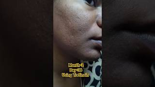 Day36 Using Tretinoin viralvideo tretinoin skincare shorts youtubeshorts [upl. by Kcirddes]